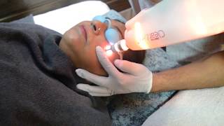 Under Eye Dark Circle and Pigmentation treatment by Q switch amp Er glass LaserGlobal Health [upl. by Lilias]