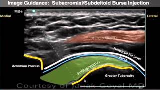 Webinar UltrasoundGuided Shoulder Injections Part 1 [upl. by Okubo]