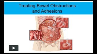 Treating Bowel Obstructions and Adhesions NonSurgically [upl. by Noteloc]