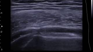 Lateral hip bursa injection on ultrasound  SAX  off plane [upl. by Eniamert]