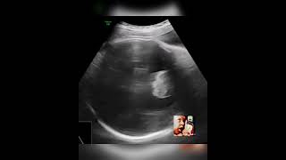 Holoprosencephaly fetal ultrasound by DrHaissam Aref DMS MSc MD ultrasound [upl. by Ninel]