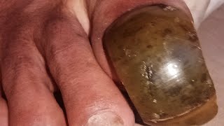 Extreme Toenail Transformation Cutting Wild amp Smelly Toenails [upl. by Allcot]