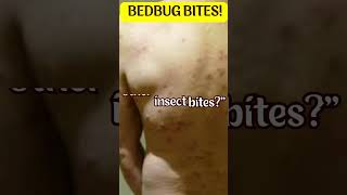 quotUnveiling the Hidden Truth Shocking Facts About Bed Bug Bites Revealedquot [upl. by Dnalon]