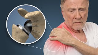 Why You Might Need Your Shoulder Replaced  Reverse Shoulder Surgery Explained Medical Animation [upl. by Daisi]