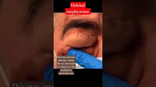 Eye Diseases Orbital emphysema viral education optometry shortsvideo ytshortsindia eye [upl. by Stiegler]