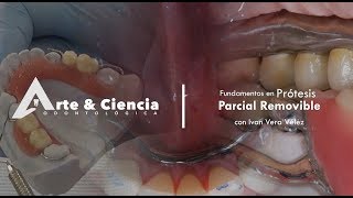 Elaboración de prótesis parcial removible FOUCE [upl. by Oderfliw]