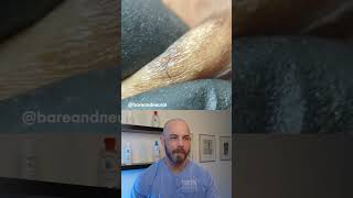 Ingrown hair frenzy ingrownhair dermreacts doctorreacts [upl. by Enilrem]