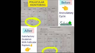 Satisfactory OVULATION STUDY results post Ayurvedic treatment [upl. by Ecnaralc]