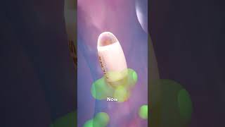 Pill Camera Explained What If It Gets Stuck 😨 [upl. by Oijres]