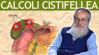 Dott Mozzi Calcoli alla cistifellea biliari colecisti [upl. by Modnar]