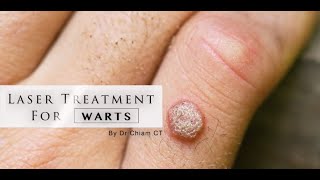 Warts removal with Laser Treatment  Dr Chiam CT [upl. by Hopper828]