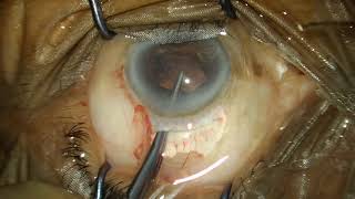 anterior vitrectomy iris claw iol [upl. by Sidonia809]