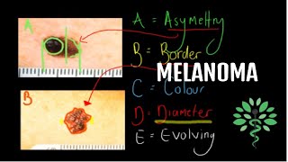 Melanoma  Symptoms signs diagnosis and management [upl. by Acnalb]