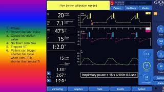 Inspiratory pause in PCV and VCV [upl. by Goraud670]