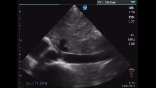 IVC Plethora on Sonosite IViz [upl. by Hahn515]