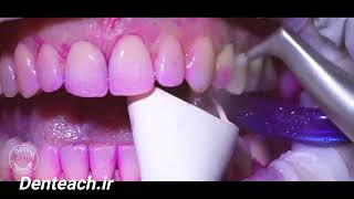 How Teeth Should Be Cleaned at the Dentist  Hygienists Guide [upl. by Ohaus448]