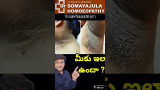 Black Neck Acanthosis  healthtipsintelugu Dr Somayajula Homeopathy [upl. by Etiuqal382]