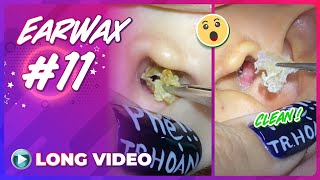 EP 11 Earwax ASMR  Series remove earwax after not cleaning for a long time [upl. by Mehitable]