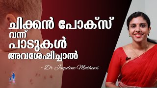 Measles  chicken pox  marks removal  ചിക്കൻ പോക്സ്  പാടുകൾ മാറ്റാൻ  Dr Jaquline Mathews BAMS [upl. by Roshan365]