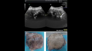 SHADOWING IN THE ADNEXA DIFFERENTIAL DIAGNOSES [upl. by Emlynn]