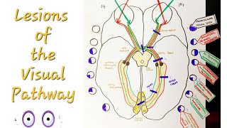 Lesions of the Visual Pathway  Optic Nerve and pathway lesions [upl. by Gallard904]