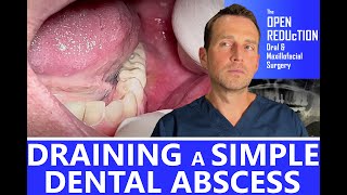 DRAINING a SIMPLE DENTAL ABSCESS [upl. by Levin]