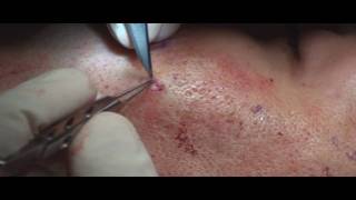 Acne Scar Revision Part 04 More Subcision Technique by Dr Young [upl. by Alcock]