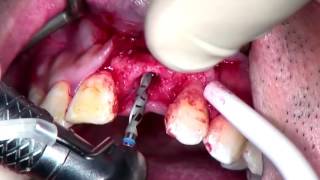 Step by Step Anterior Implant placement with GBR with voiceover [upl. by Lunette]