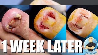 HEALING PROCESS OF AN INFECTED INGROWN TOENAIL [upl. by Alleuqcaj435]