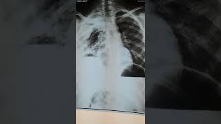 Is it hydropneumothorax really [upl. by Erreid]