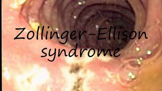 How to Pronounce ZollingerEllison syndrome [upl. by Rahman]