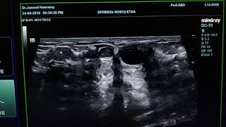 Intraductal Papilloma Sonography [upl. by Triley]