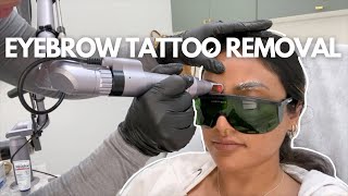 GETTING MY EYEBROW TATTOO REMOVED  Microblading Pico Laser Tattoo Removal Healing Process [upl. by Seraphine96]