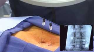 WATCH an Epidural Steroid Injection Demonstration  LIVE [upl. by Ennasirk]