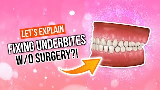 How To Fix An UNDERBITE Without Surgery [upl. by Ayahsey36]