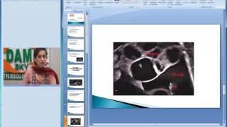 Dr Deepti Bahl  Ovarian Hyperstimulation Syndrome DAMS USMLE NEETPG AIIMS [upl. by Riabuz]