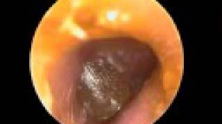 Acute Otitis media tympanic blister [upl. by Analad]