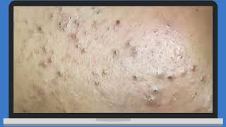 Punti Neri Acne Blackheads Removal pt2 [upl. by Annetta]