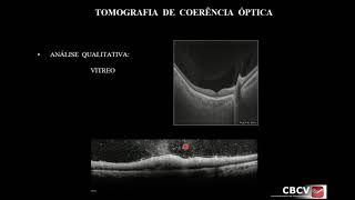 OCT  Tomografia de Coerência Óptica  Dra Erika Pacheco Magalhães Diniz [upl. by Paddy158]