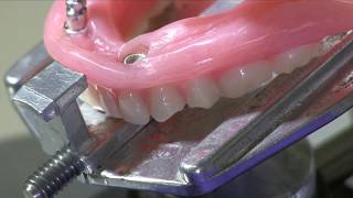 Eliminating Attachment Binding in Implant Overdentures [upl. by Olvan]