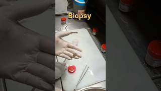 Small excision biopsy sample [upl. by Clite]