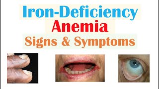 IronDeficiency Anemia Signs amp Symptoms ex Fatigue “Spoon Nails” Cracked Lips [upl. by Duff]