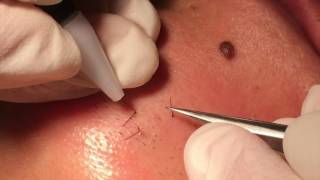 Electrolysis hair removal close up [upl. by Coriss162]