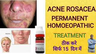 ACNE ROSACEA HOMOEOPATHIC TREATMENT [upl. by Watkins]