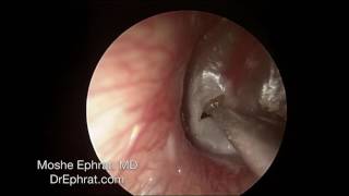 ENDOCSOPIC MUCOID OTITIS MEDIA DRAINAGE [upl. by Samale]