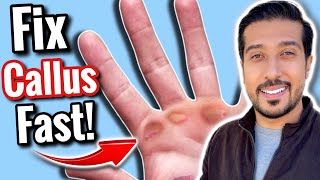 How to Get Rid of Calluses FAST in 5 EASY Steps [upl. by Warfourd]