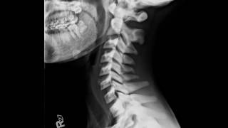 Osteopetrosis [upl. by Garner]