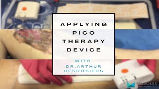 DrArthurMiami applying the PICO negative pressure wound therapy device [upl. by Auqinihs]