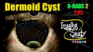 Adnexal Dermoid Cyst  Mature Cystic Teratoma  ORADS 2  Ultrasound  TVS  Case 316 [upl. by Sire]