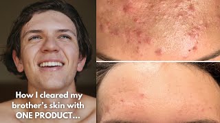 How I Cleared My Brothers Acne Texture amp Clogged Pores With One Product  Jadeywadey180 [upl. by Okoy]